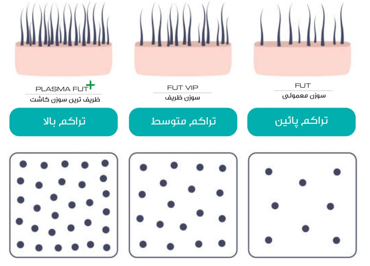 تراکم بالا در کاشت ابرو